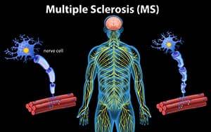 Szklerózis Multiplex kezelése, izommerevség kezelése CBD-vel
