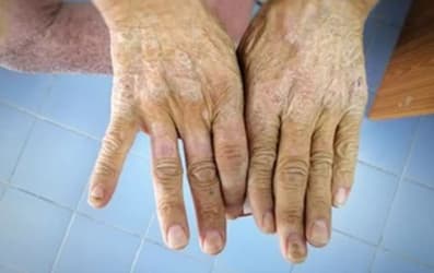 Szkleroderma kezelése szklerodermás bőrbetegség